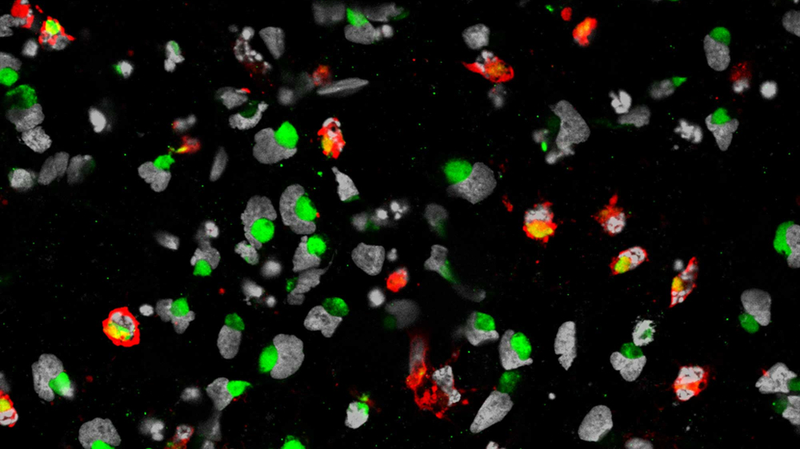 Imagen microscópica de la muerte de células progenitoras neuronales. Células madre en gris, virus del Zika en verde y células más afectadas en rojo (Sarah C. Ogden)